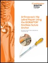 New knotless anchor for labral repair of the hip for Smith and Nephew Endoscopy